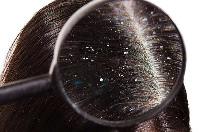 Scabs On Your Scalp Are Pretty Common But How Do you Treat Them