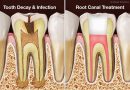 A guide to root canal treatment