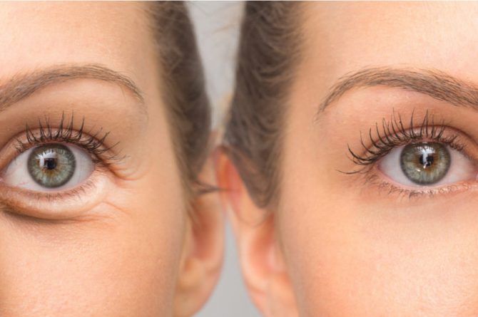 Eye Bag Removal Singapore: How much does it Cost to Remove Eye Bags?