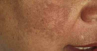 I Need Melasma Treatment: What Treatments are Best for Melasma on the Face?