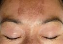 Melasma Laser Treatment Singapore: Can Melasma be removed with Laser?