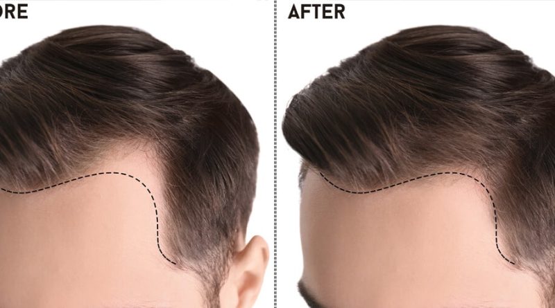 Best Hair Transplant in Pakistan