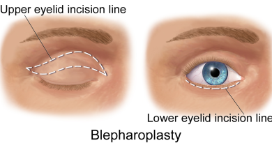 Lower Eyelid Surgery