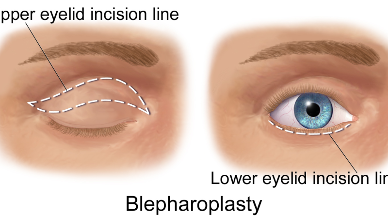 Lower Eyelid Surgery