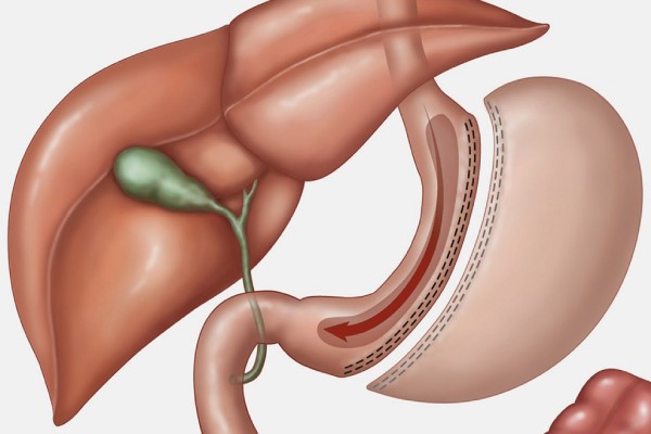 How to Locate a Gastric Sleeve Specialist Surgery for Care