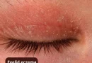 Dermatitis under the eye