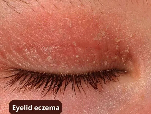 Dermatitis under the eye