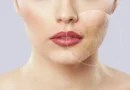 Facial Scar Removal