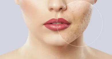 Facial Scar Removal