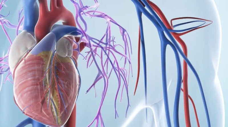 CABG Bypass