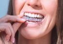 invisalign cost london