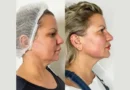 Endolift Doctors in Dubai
