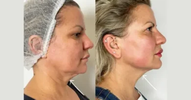 Endolift Doctors in Dubai