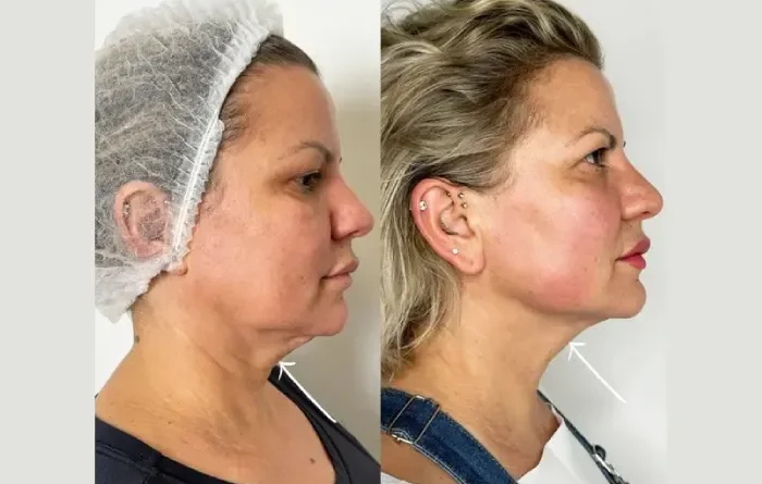 Endolift Doctors in Dubai