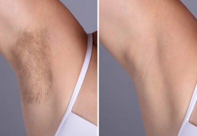 Laser hair removal in Dubai