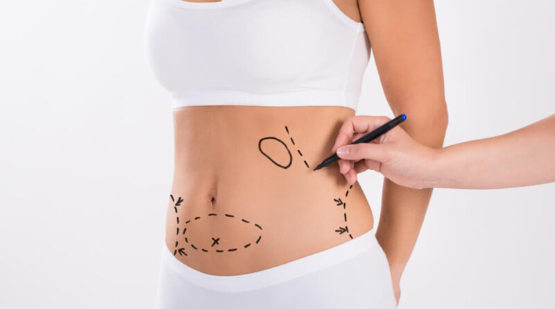 Liposuction in Dubai