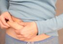 Liposuction in Dubai