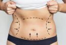 Liposuction in Dubai