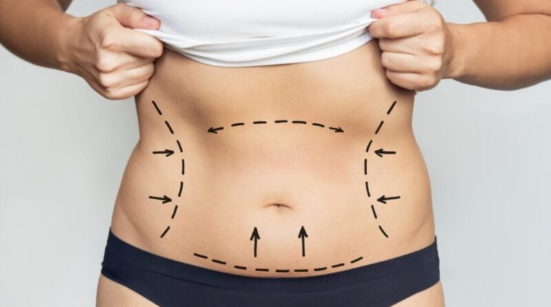Liposuction in Dubai