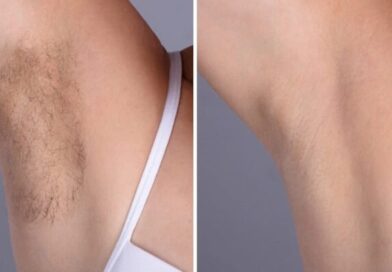 Laser hair removal in Dubai