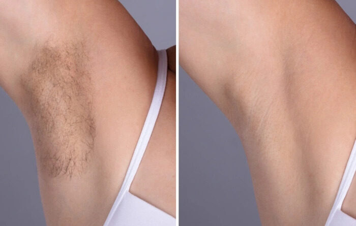 Laser hair removal in Dubai