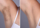 Laser hair removal in Dubai