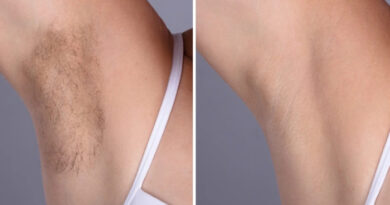 Laser hair removal in Dubai
