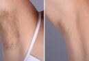 Laser hair removal in Dubai